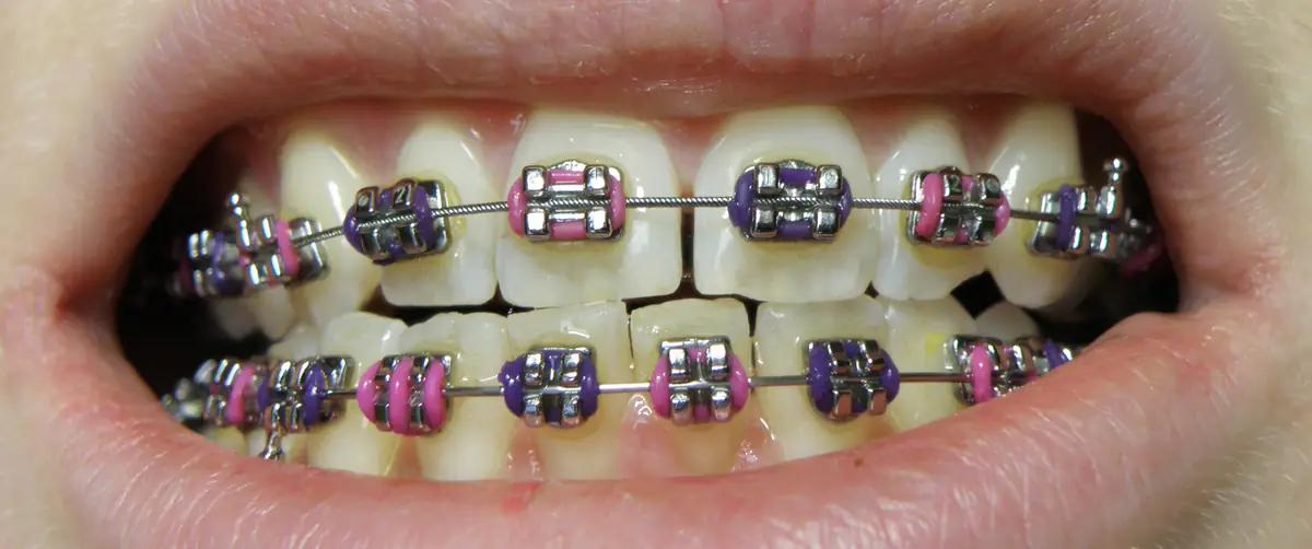 Brackets metálicos en la dentición superior e inferior (foto de ejemplo)