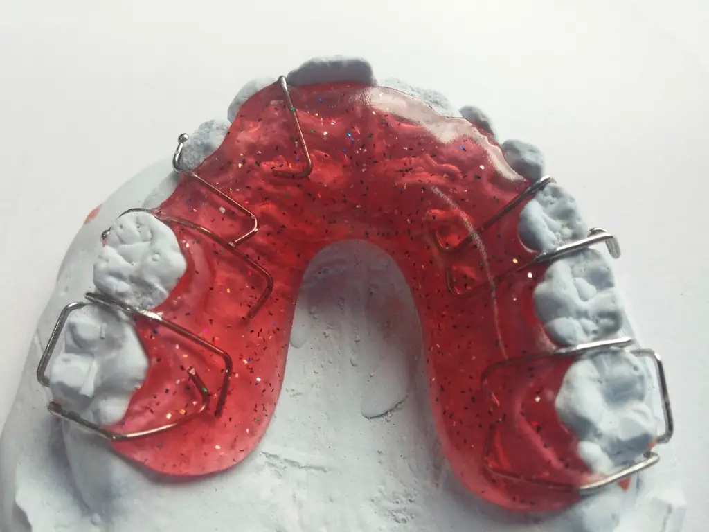 Brackets estéticos discretos (foto de ejemplo)